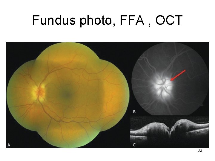 Fundus photo, FFA , OCT 32 