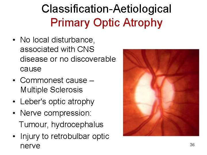 Classification-Aetiological Primary Optic Atrophy • No local disturbance, associated with CNS disease or no