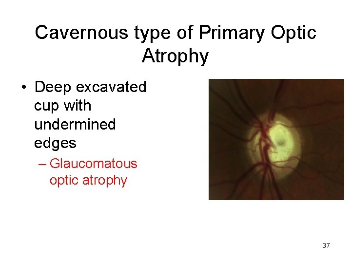 Cavernous type of Primary Optic Atrophy • Deep excavated cup with undermined edges –