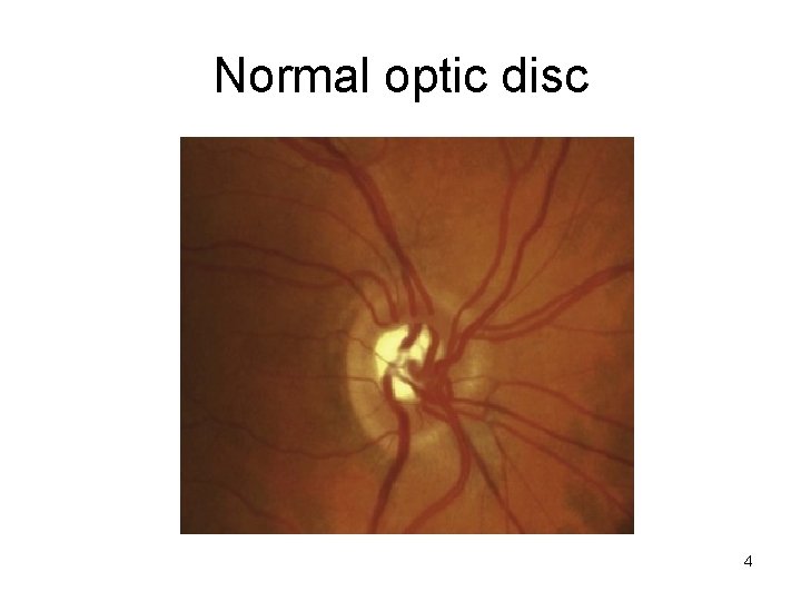 Normal optic disc 4 