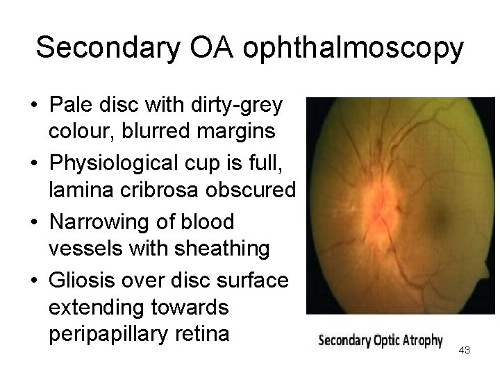 Secondary OA ophthalmoscopy • Pale disc with dirty-grey colour, blurred margins • Physiological cup