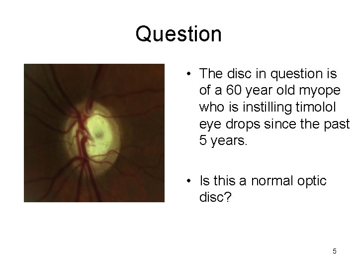 Question • The disc in question is of a 60 year old myope who