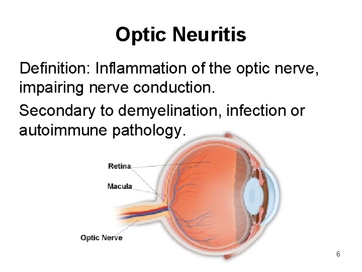 Optic Neuritis Definition: Inflammation of the optic nerve, impairing nerve conduction. Secondary to demyelination,