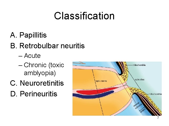 Classification A. Papillitis B. Retrobulbar neuritis – Acute – Chronic (toxic amblyopia) C. Neuroretinitis