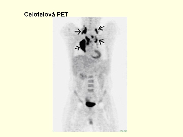 Celotelová PET 