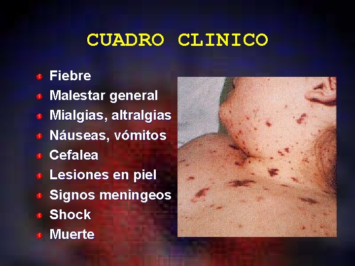 CUADRO CLINICO Fiebre Malestar general Mialgias, altralgias Náuseas, vómitos Cefalea Lesiones en piel Signos