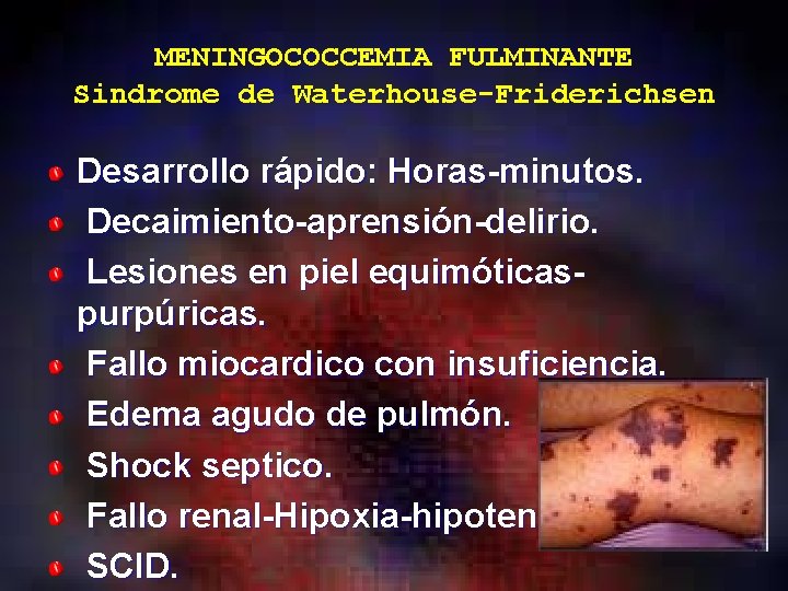 MENINGOCOCCEMIA FULMINANTE Sindrome de Waterhouse-Friderichsen Desarrollo rápido: Horas-minutos. Decaimiento-aprensión-delirio. Lesiones en piel equimóticaspurpúricas. Fallo