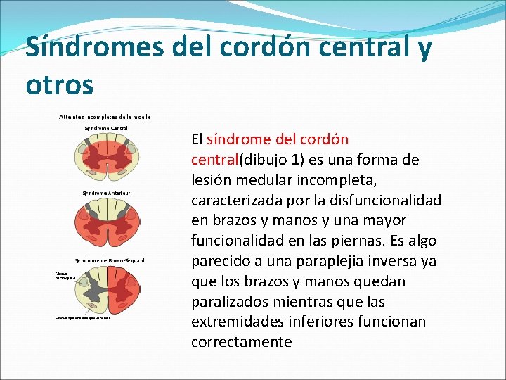 Síndromes del cordón central y otros El síndrome del cordón central(dibujo 1) es una