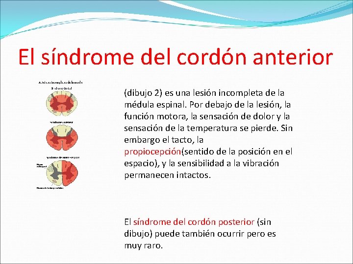 El síndrome del cordón anterior (dibujo 2) es una lesión incompleta de la médula