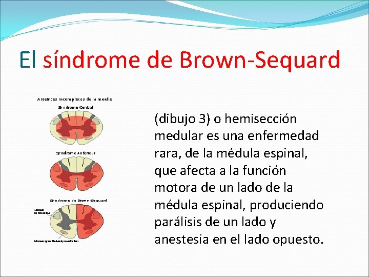 El síndrome de Brown-Sequard (dibujo 3) o hemisección medular es una enfermedad rara, de