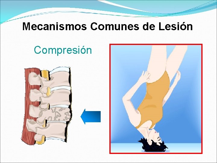 Mecanismos Comunes de Lesión Compresión 