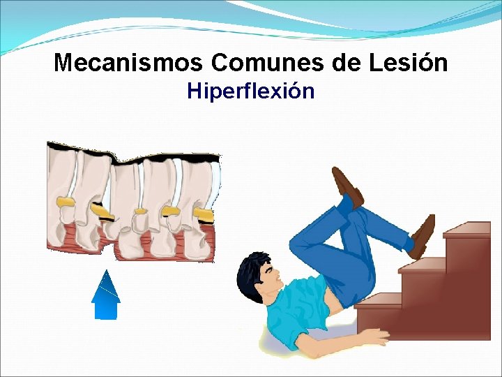 Mecanismos Comunes de Lesión Hiperflexión 