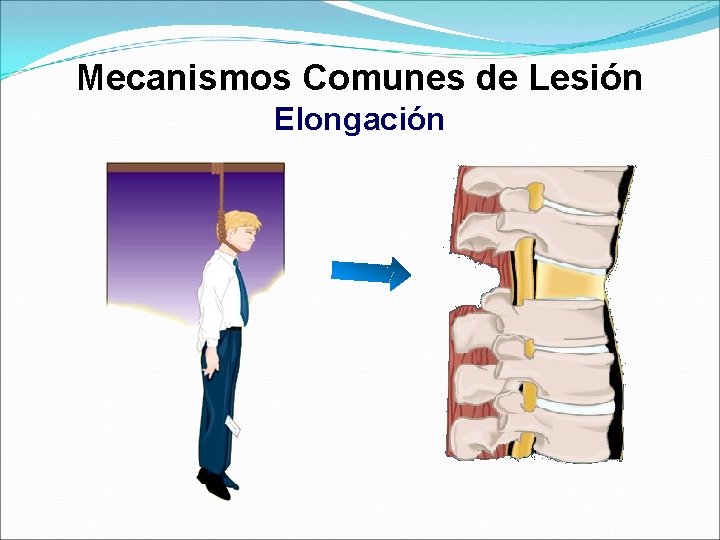 Mecanismos Comunes de Lesión Elongación 