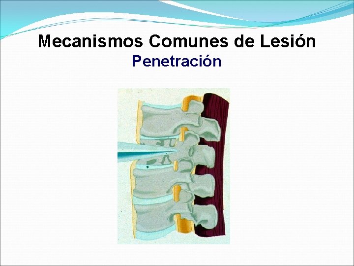 Mecanismos Comunes de Lesión Penetración 