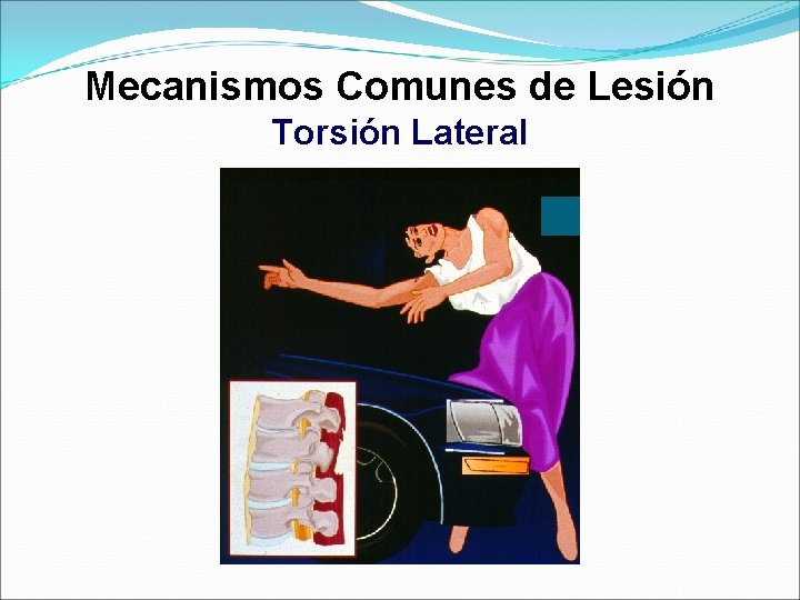 Mecanismos Comunes de Lesión Torsión Lateral 