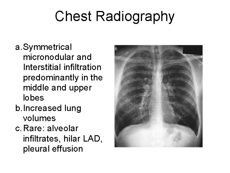 Chest Radiography a. Symmetrical micronodular and Interstitial infiltration predominantly in the middle and upper