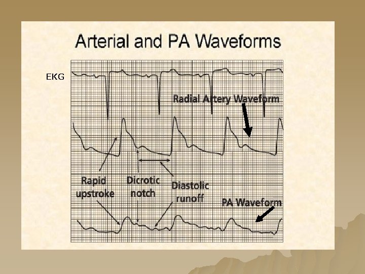EKG EKG