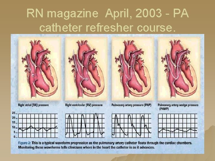 RN magazine April, 2003 - PA catheter refresher course. RN magazine April, 2003 - PA catheter refresher course.