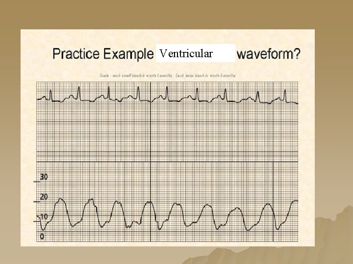 Ventricular Ventricular