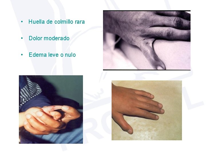  • Huella de colmillo rara • Dolor moderado • Edema leve o nulo