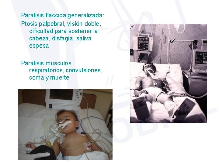 Parálisis fláccida generalizada: Ptosis palpebral, visión doble, dificultad para sostener la cabeza, disfagia, saliva