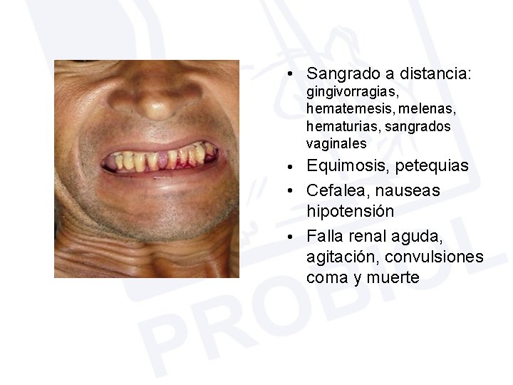  • Sangrado a distancia: gingivorragias, hematemesis, melenas, hematurias, sangrados vaginales • Equimosis, petequias