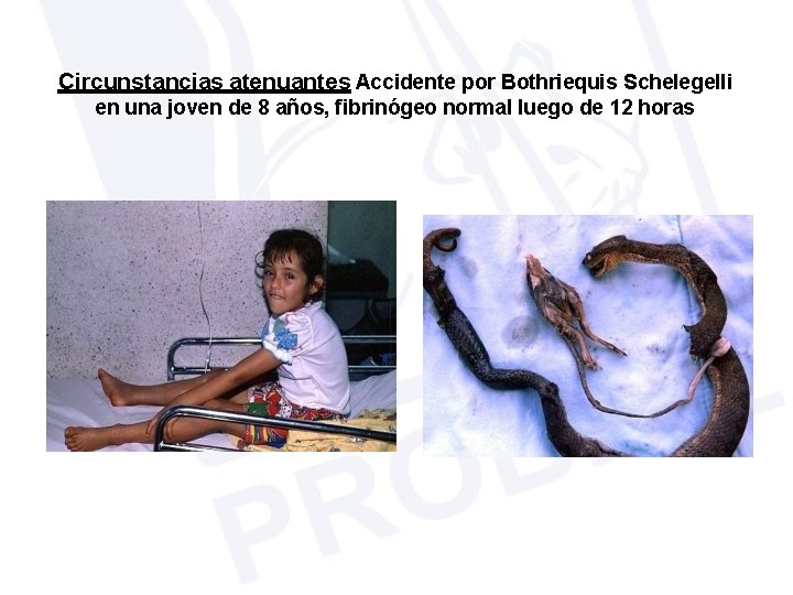 Circunstancias atenuantes Accidente por Bothriequis Schelegelli en una joven de 8 años, fibrinógeo normal