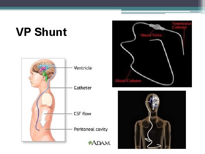 VP Shunt VP Shunt