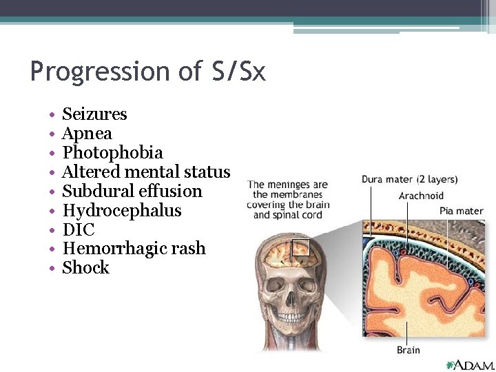 Progression of S/Sx • • • Seizures Apnea Photophobia Altered mental status Subdural effusion Progression of S/Sx • • • Seizures Apnea Photophobia Altered mental status Subdural effusion
