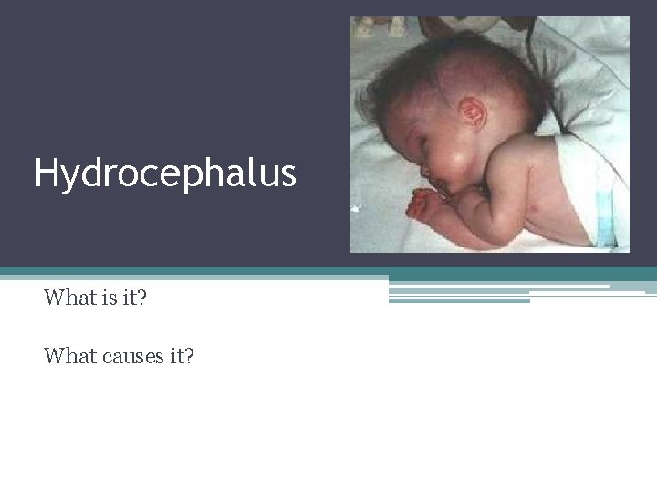 Hydrocephalus What is it? What causes it? Hydrocephalus What is it? What causes it?
