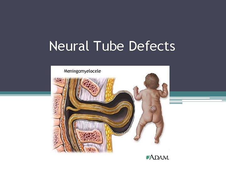 Neural Tube Defects Neural Tube Defects