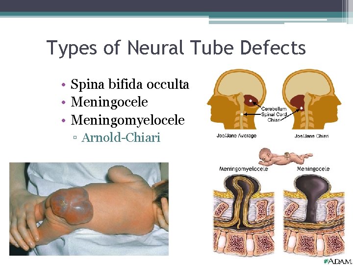 Types of Neural Tube Defects • Spina bifida occulta • Meningocele • Meningomyelocele ▫ Types of Neural Tube Defects • Spina bifida occulta • Meningocele • Meningomyelocele ▫