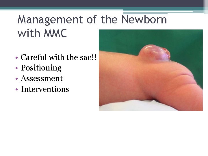 Management of the Newborn with MMC • • Careful with the sac!! Positioning Assessment Management of the Newborn with MMC • • Careful with the sac!! Positioning Assessment