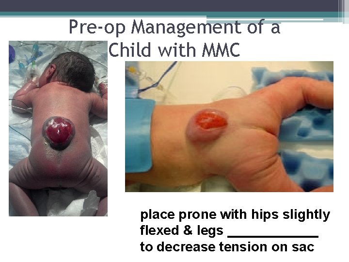 Pre-op Management of a Child with MMC place prone with hips slightly flexed & Pre-op Management of a Child with MMC place prone with hips slightly flexed &