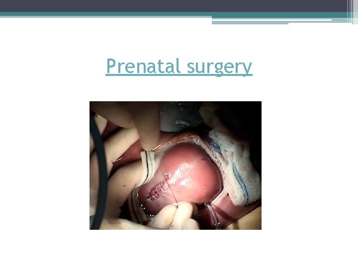 Prenatal surgery Prenatal surgery