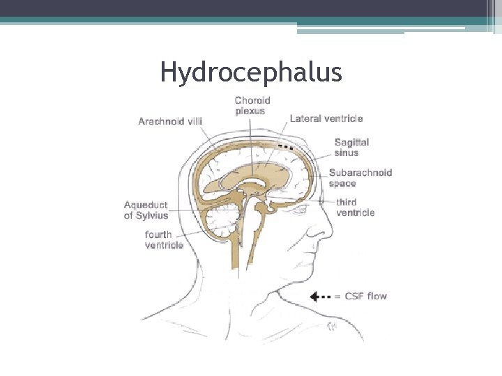 Hydrocephalus Hydrocephalus