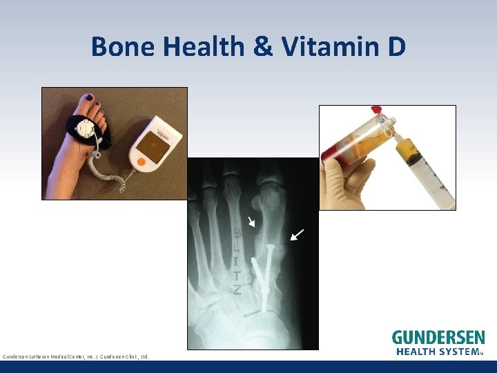 Bone Health & Vitamin D Gundersen Lutheran Medical Center, Inc. | Gundersen Clinic, Ltd.