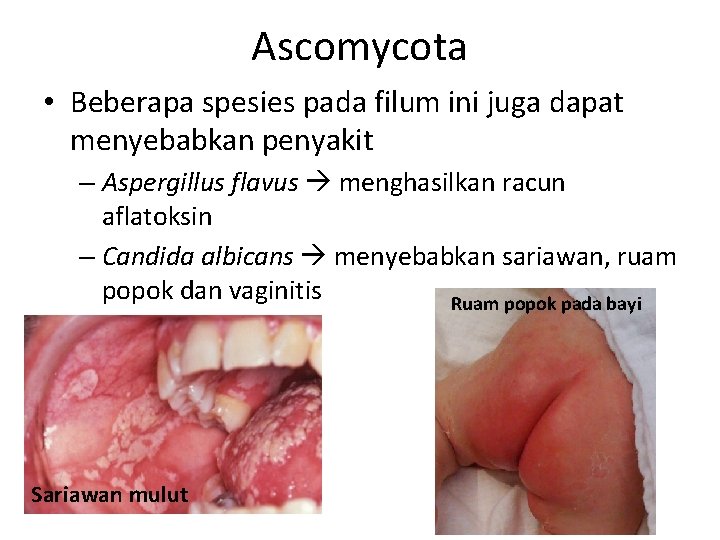 Ascomycota • Beberapa spesies pada filum ini juga dapat menyebabkan penyakit – Aspergillus flavus