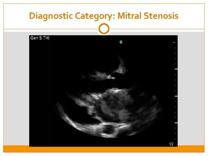 Diagnostic Category: Mitral Stenosis 