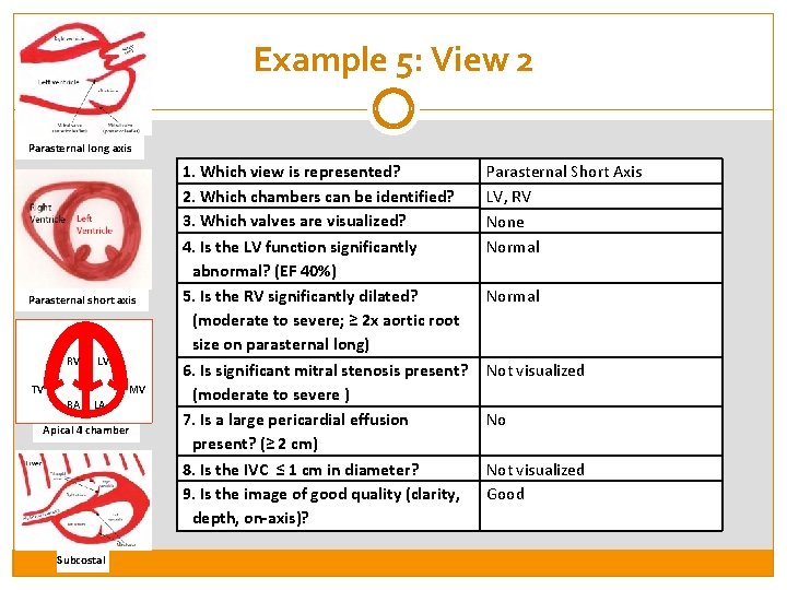 Example 5: View 2 Parasternal long axis Parasternal short axis RV LV TV MV