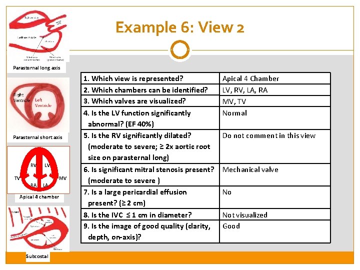 Example 6: View 2 Parasternal long axis Parasternal short axis RV LV TV MV