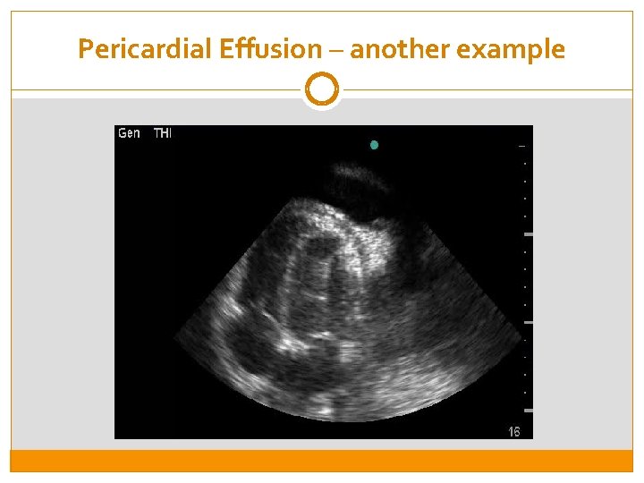 Pericardial Effusion – another example 