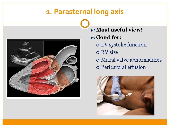 1. Parasternal long axis Most useful view! Good for: LV systolic function RV size