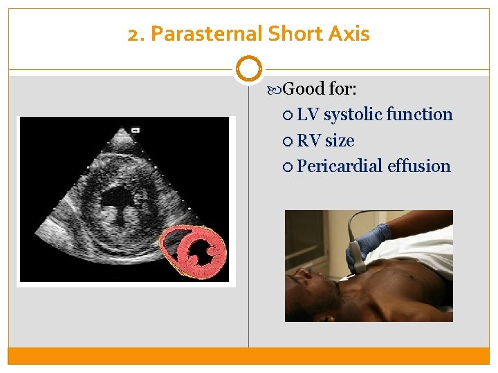 2. Parasternal Short Axis Good for: LV systolic function RV size Pericardial effusion 