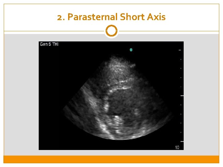 2. Parasternal Short Axis 