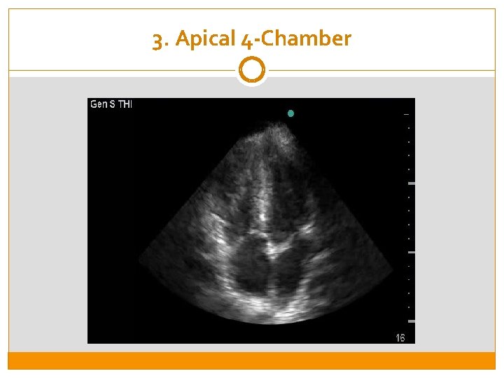 3. Apical 4 -Chamber 