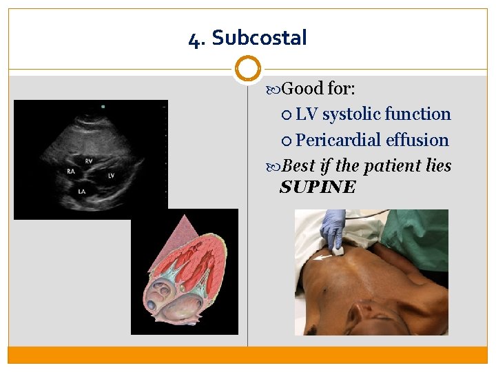 4. Subcostal Good for: LV systolic function Pericardial effusion Best if the patient lies