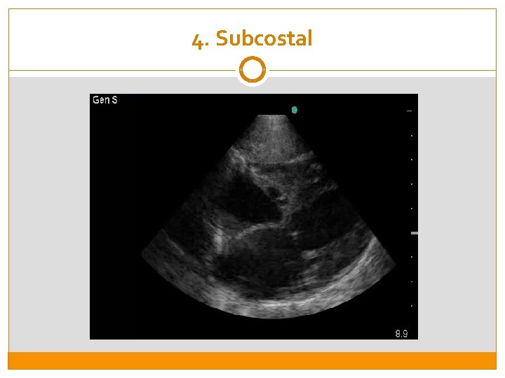 4. Subcostal 