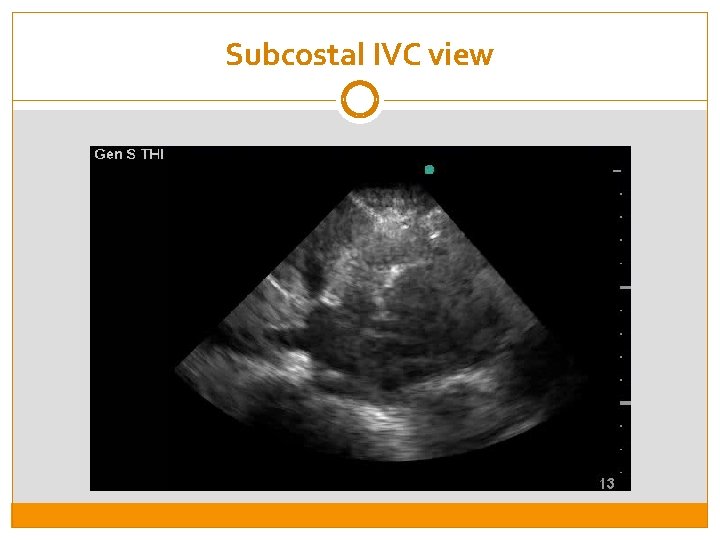 Subcostal IVC view 