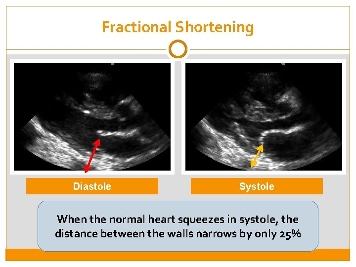 Fractional Shortening Diastole Systole In a cross-sectional view, the distance between the walls of